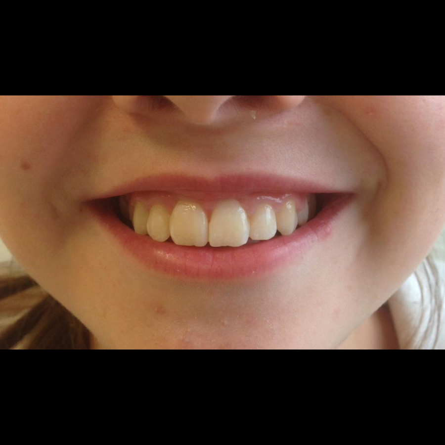 Teenage Braces - Costs and Other Questions - Kids Braces - after - 3Dental
